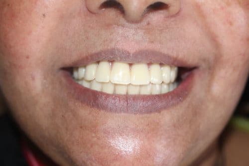 Understanding Dental Implants: Your Questions Answered
